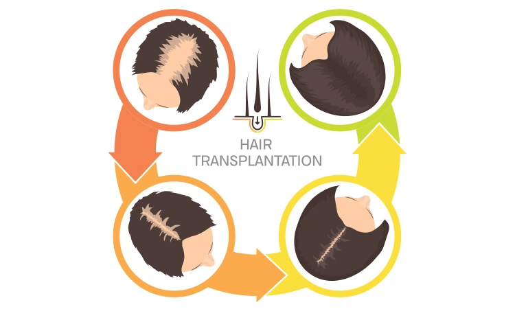 Hairstyles for female pattern hair loss